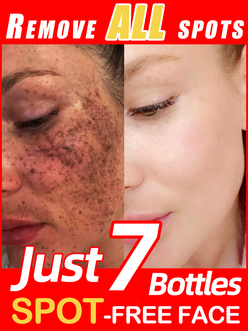 Çilleri, Melazmayı ve Yüzdeki  - Luxury Skincare Essence incelemesi ve fiyatı